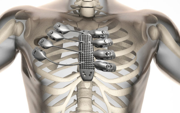 An example of making a part of titanium ribs